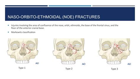 Nasal Bone Fractures.pptx