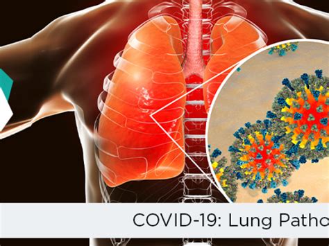 COVID-19 and related Lung Pathology | Blog by CB Physiotherapy, Active ...