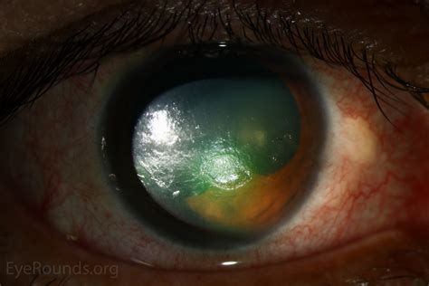 Neurotrophic Corneal Ulcer Infectious Keratitis In A Neurotrophic