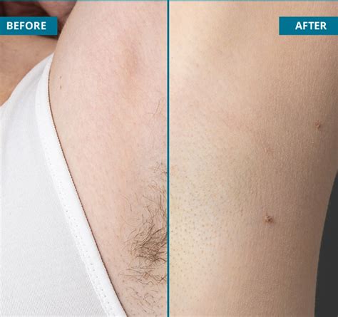 Body Perfect | Laser Hair Removal Treatment Bangalore | Hair Removal ...