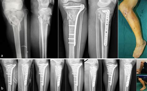 Image result for Open Fracture Surgery