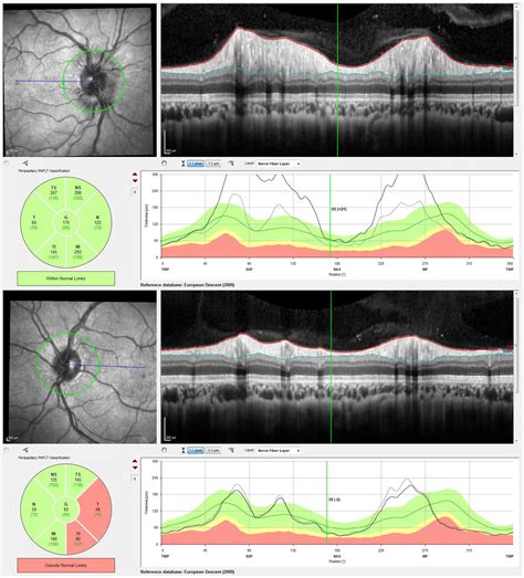 Foster Kennedy syndrome secondary to a giant prolactinoma with a remarkable response to ...