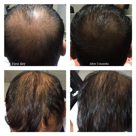 Buy Hair Growth Combo Online | Be Pure Naturals