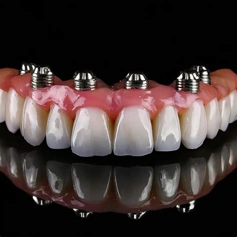 All-on-6 Dental Implants: Best Types & Materials Guide