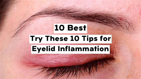 10 Best Tips for Eyelid Inflammation - YouTube