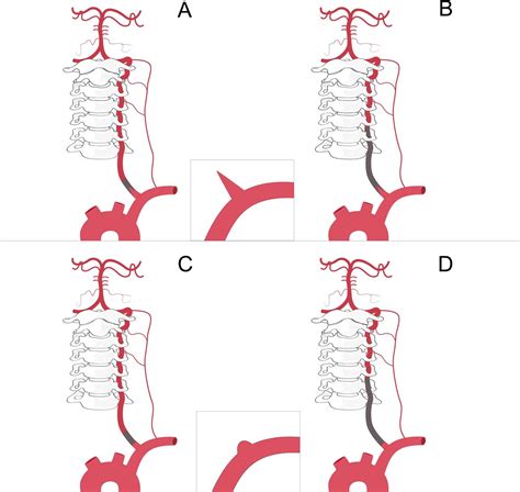 A novel angiographic classification for the endovascular recanalization of symptomatic nonacute ...