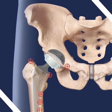 Anterior Hip Replacement Benefits and Recovery - AHF - Anterior Hip ...