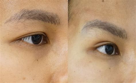 Image result for Fox Eye Thread Lift Procedure
