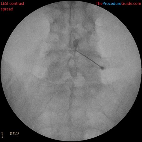 Image result for What Is a Fluoroscopy Injection