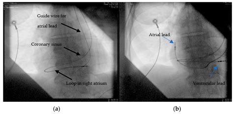 Cardiac Implantable Electronic Devices in Different Anatomical Types of ...