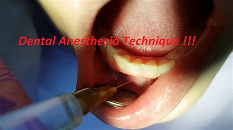 Extraoral Technique of Local Anesthesia 的图像结果