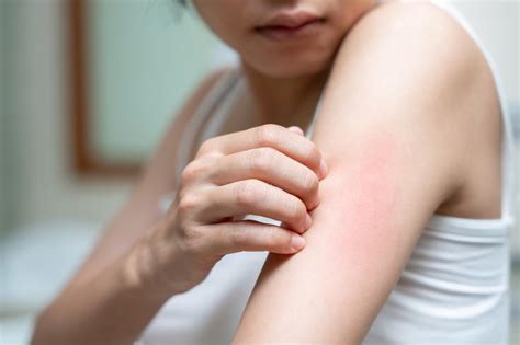 Dermatitis atópica, una enfermedad que afecta la salud mental de hasta ...