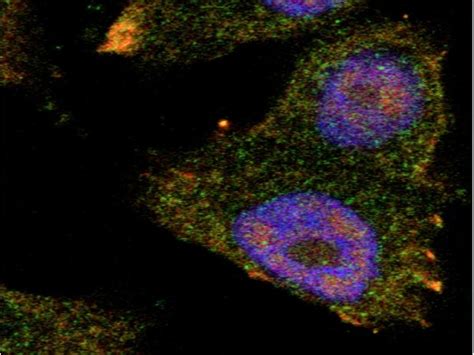 Discovery gives hope of detecting, preventing prostate cancer spread