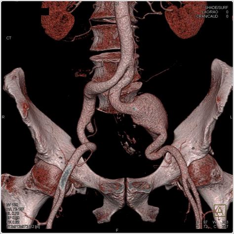 Left Common Iliac Artery Aneurysm - Vascular Radiology Case Studies ...