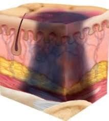 Image result for Deep Tissue Injuries