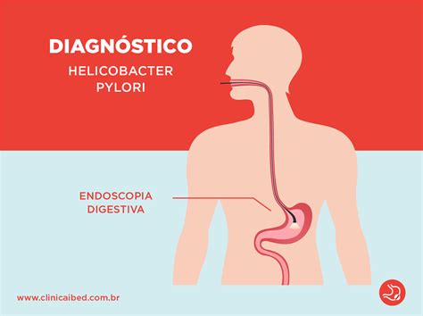 Helicobacter pylori (H. pylori): Sintomas, diagnóstico e tratamento - Clínica IBED