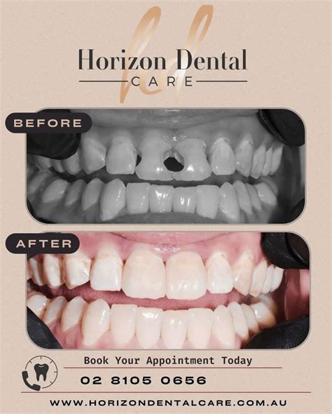 Horizon Dental Care (@horizondentalcareleppington) • Instagram photos ...