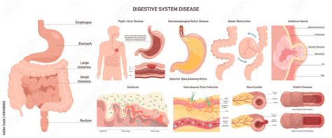 Digestive System Diseases 的图像结果