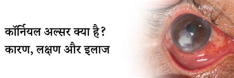 कॉर्नियल अल्सर क्या है? कारण, लक्षण और इलाज | What is Corneal Ulcer in ...