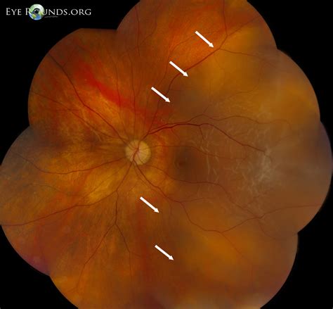 Vitreous Syneresis: An Impending Posterior Vitreous Detachment (PVD)