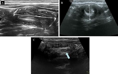 Intussusception Ultrasound