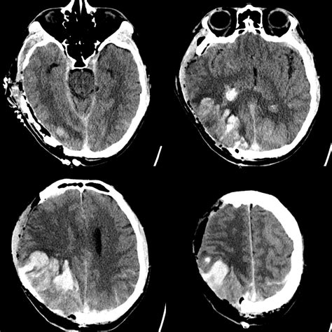 Superior Sagittal Sinus Thrombosis