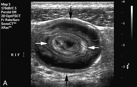 Intussusception Claw Sign