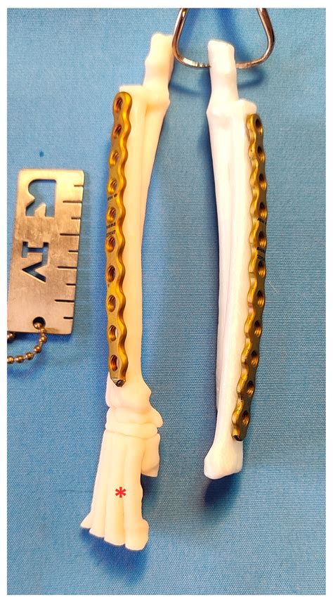 Minimally Invasive Plate Osteosynthesis (MIPO) of Comminuted Radial ...