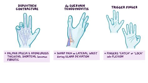 Smith Fracture Cast Position at Kelley Nichols blog