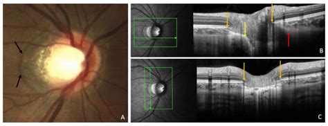 Interpupillary Distance and Peripapillary Myopic Changes: A Pilot Study ...