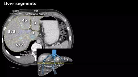 LIVER SEGMENT ANATOMY CT SCAN | PPTX | Digestive Disorders | Diseases and Conditions