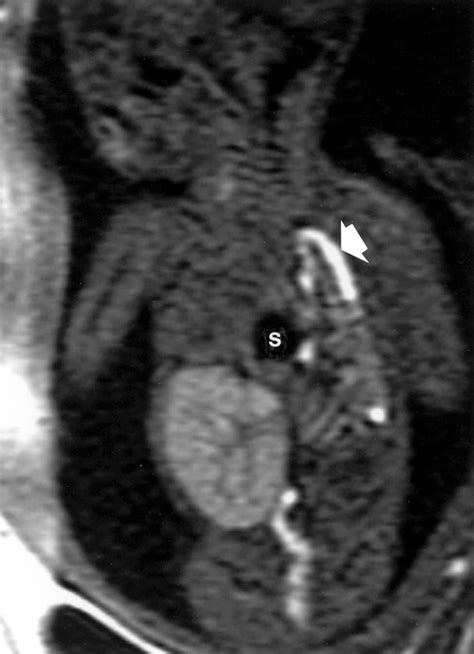 Congenital Diaphragmatic Hernia Ultrasound