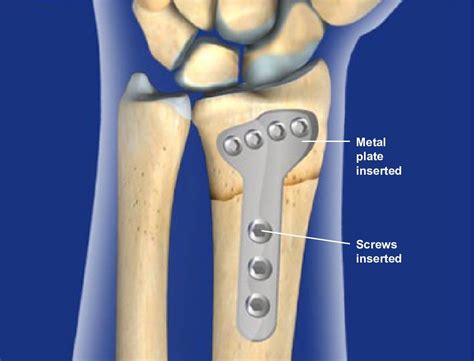 Image result for Distal Radius Fracture Recovery