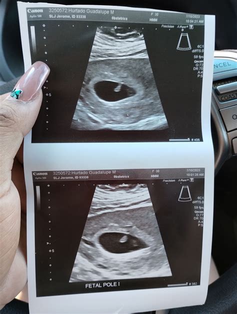 7 week ultrasounds. | BabyCenter