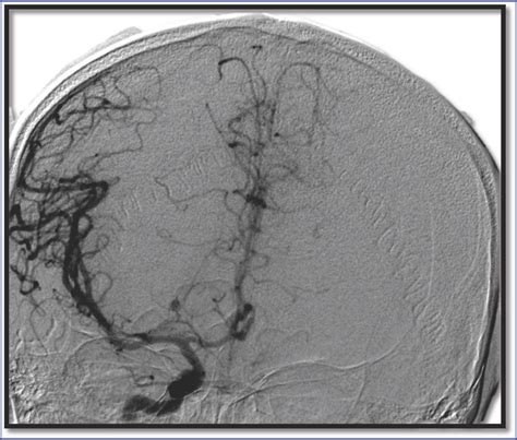 Abstract 303: Incidental discovery of Charcot‐Bouchard Aneurysm in a Patient with Fisher type 1 ...