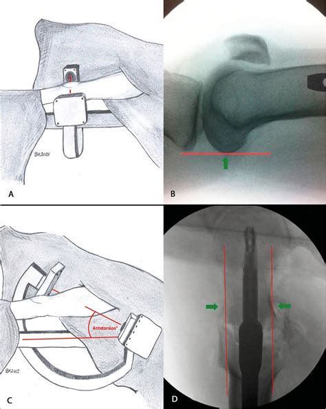Rotationsfehler nach Marknagelung der unteren Extremität ...