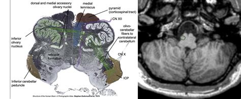 Superior Olivary Nucleus