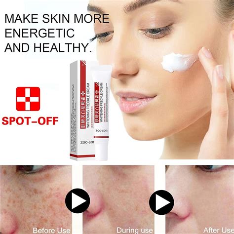 Spot Off Freckle Whitening & Dark Spot Corrector Cream - Acne Scar & Melasma Removal Treatment ...