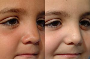 Septum Spur Correction With Septoplasty - Health, Beauty & Fitness ...