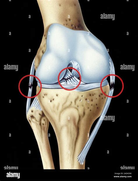 Knee ligament injuries, illustration. Three typical ruptures (red ...