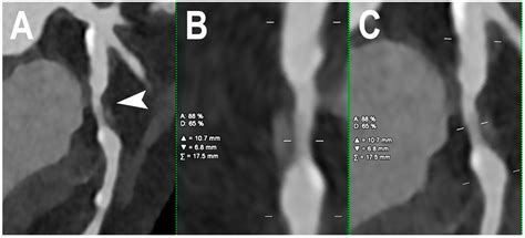 Dual-Source Photon-Counting Computed Tomography—Part I: Clinical Overview of Cardiac CT and ...