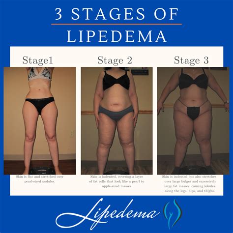 Follow These 4 Steps to a Lipedema Diagnosis | Lipedema.Net