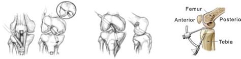 Anterior Cruciate Ligament Tears | JointSurgery.in
