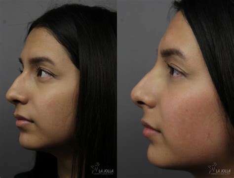 Non Surgical Nose Job Before & After Gallery: Patient 3