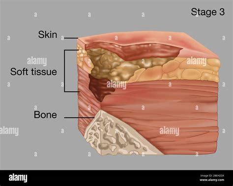 Pressure ulcer stage hi-res stock photography and images - Alamy