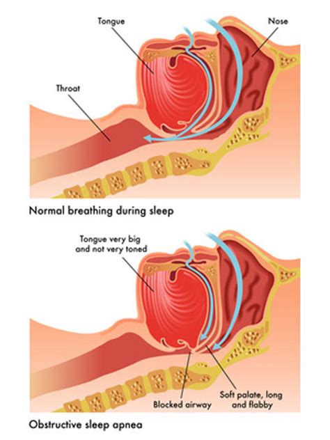Image result for Obstructive Sleep Apnea