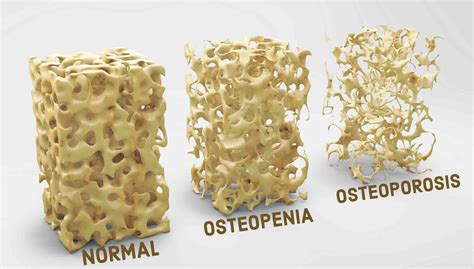 Que Es La Osteoporosis