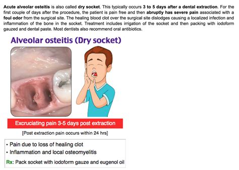 Dry socket symptoms proven treatments safe foods prevention – Artofit