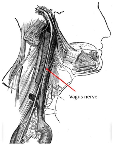 Vagus Nerve Stimulation in Stroke Management: Brief Review of Evolution ...