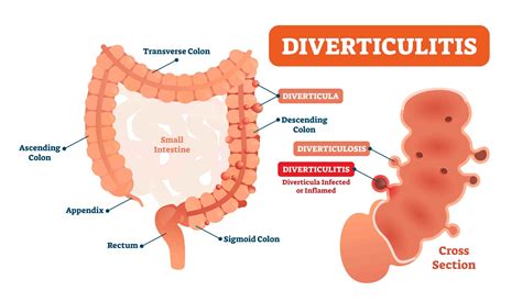 Alimentation Diverticules Intestinales – PPWBP
